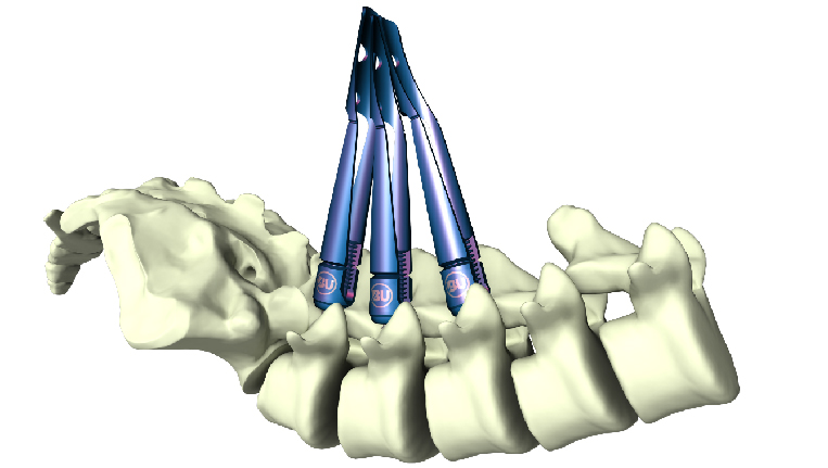 NOVA Minimal Invasive Spinal System / BAUI Biotech Co.,Ltd.