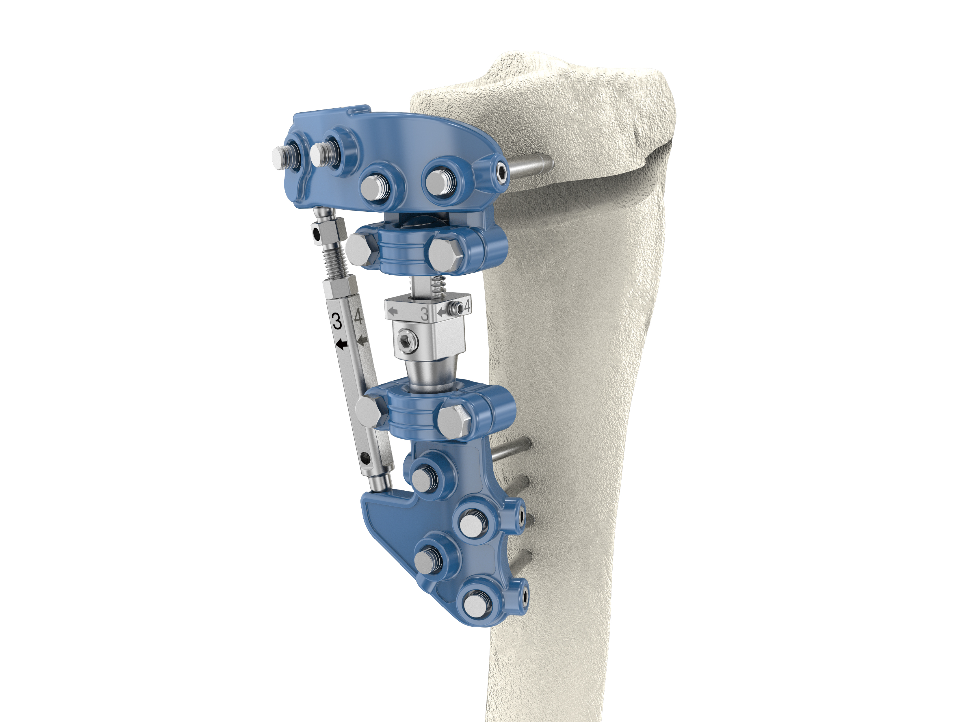 PK High Tibial Osteotomy Correction System