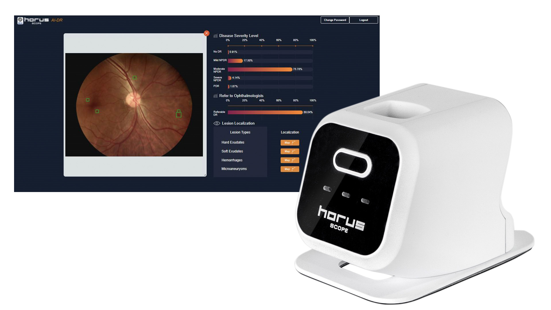 AI-assisted Diagnostic Device for Diabetic Retinopathy